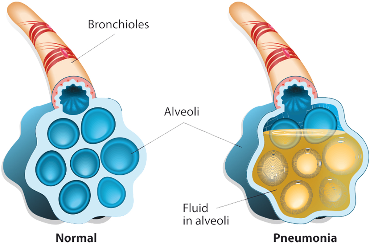 pneumonia fever treatment