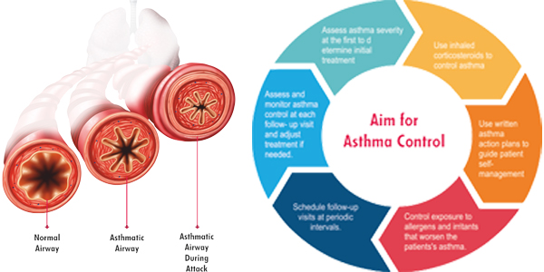 best asthma doctor in delhi