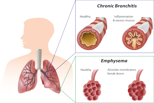 The overall approach to managing stable COPD